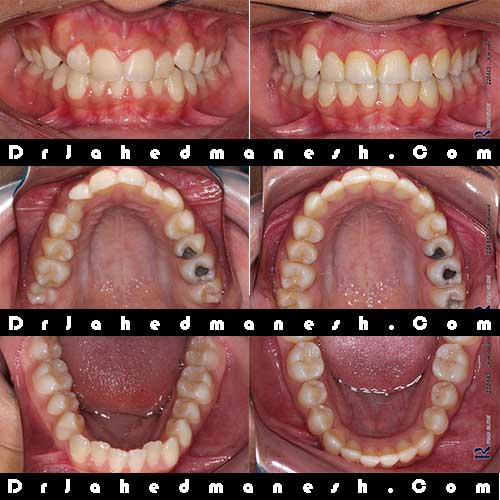 نهفتگی دندان عقل