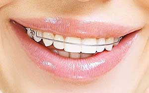 ارتودنسی فانکشنال