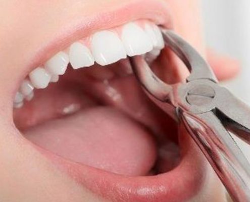 کشیدن دندان قبل از انجام ارتودنسی