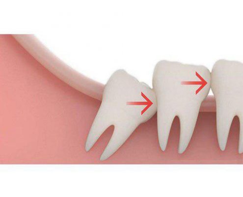 علل کشیدن دندان عقل