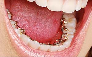 ارتودنسی لینگوال