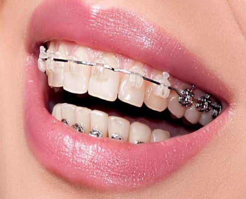 نحوه مراقبت دستگاه ارتودنسی