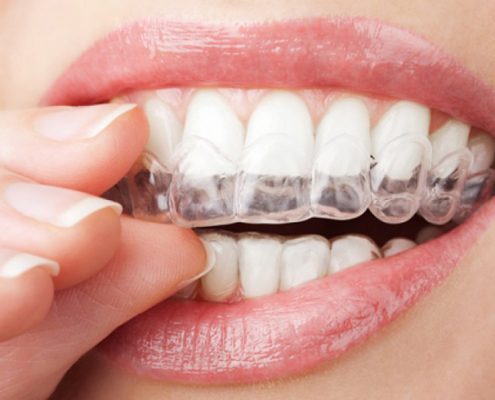 دستگاه ارتودنسی نامرئی